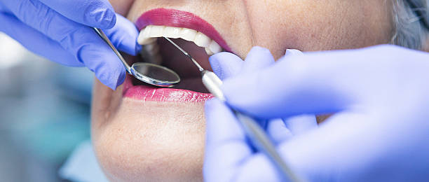 Best Teeth Whitening  in Robins, IA